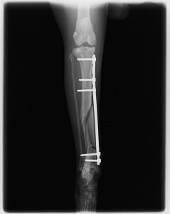 Técnica MIPO 1